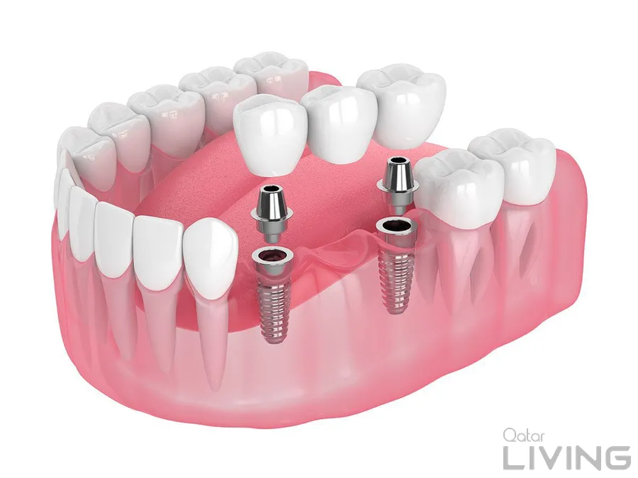 Dental Implant & 3D X-Ray Bundle